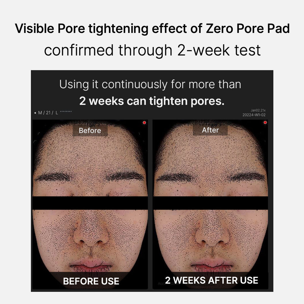 Mirco Pore Pads (AHA + BHA) | Cuidado de la piel propensa al acné