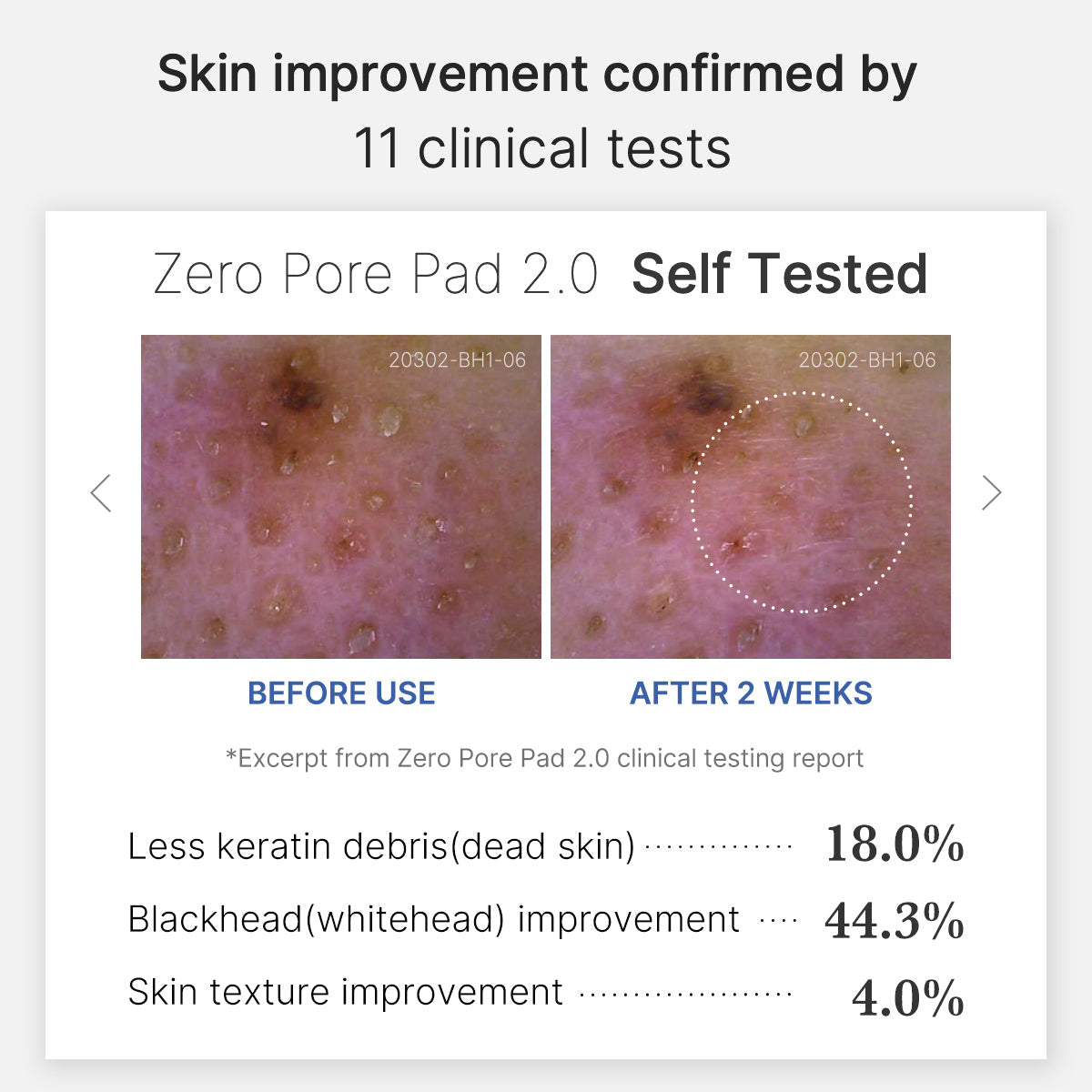Mirco Pore Pads (AHA + BHA) | Cuidado de la piel propensa al acné