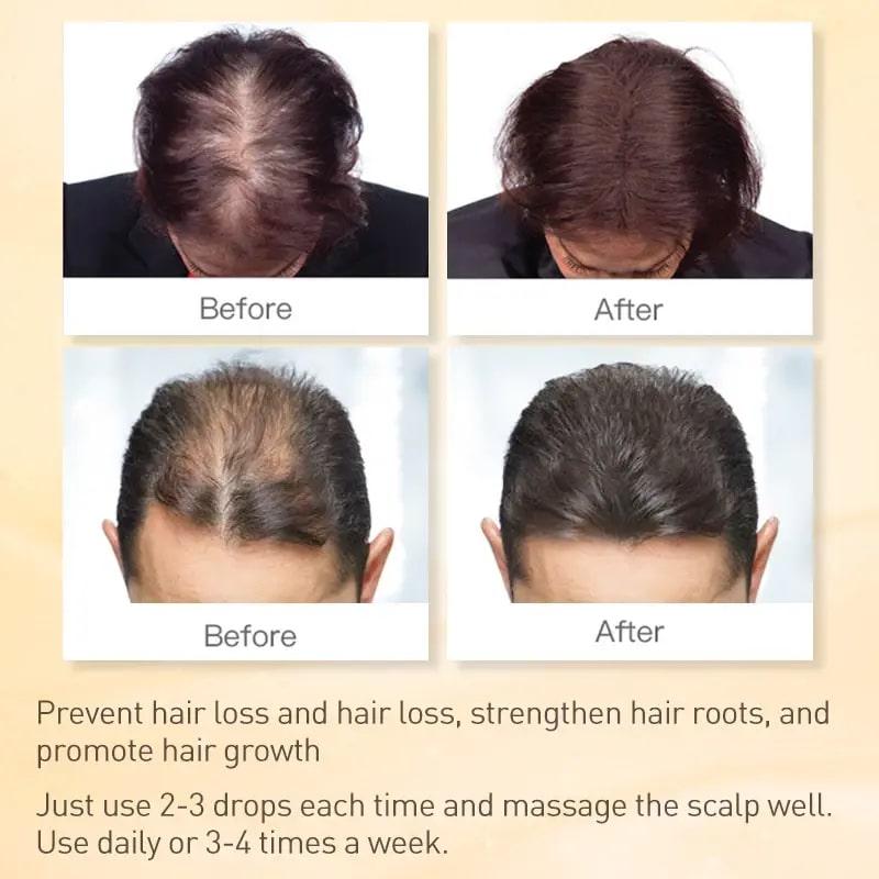 Estimulante del cuero cabelludo con jengibre | Suero para el crecimiento del cabello 