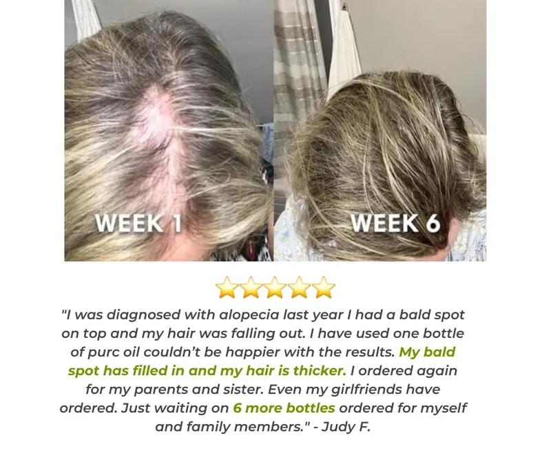 Estimulante del cuero cabelludo con jengibre | Suero para el crecimiento del cabello 