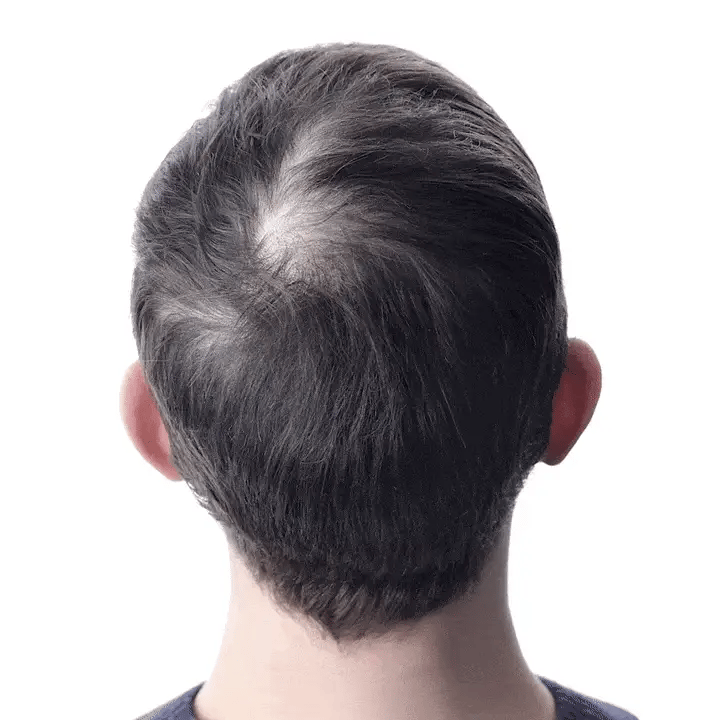 ✅🇺🇸 Developed by Trichologists：High-Concentration Minoxidil Hair Regrowth Serum