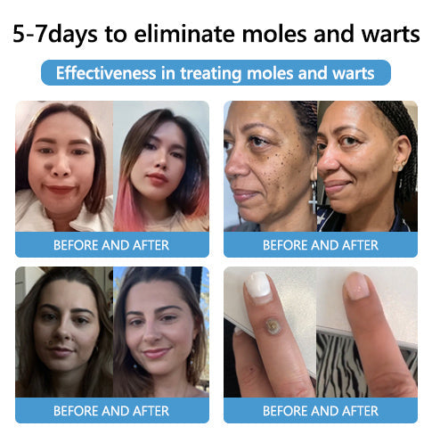 Acne Drying Lotion – Fights Inflamed & Pus-Filled Pimples Fast