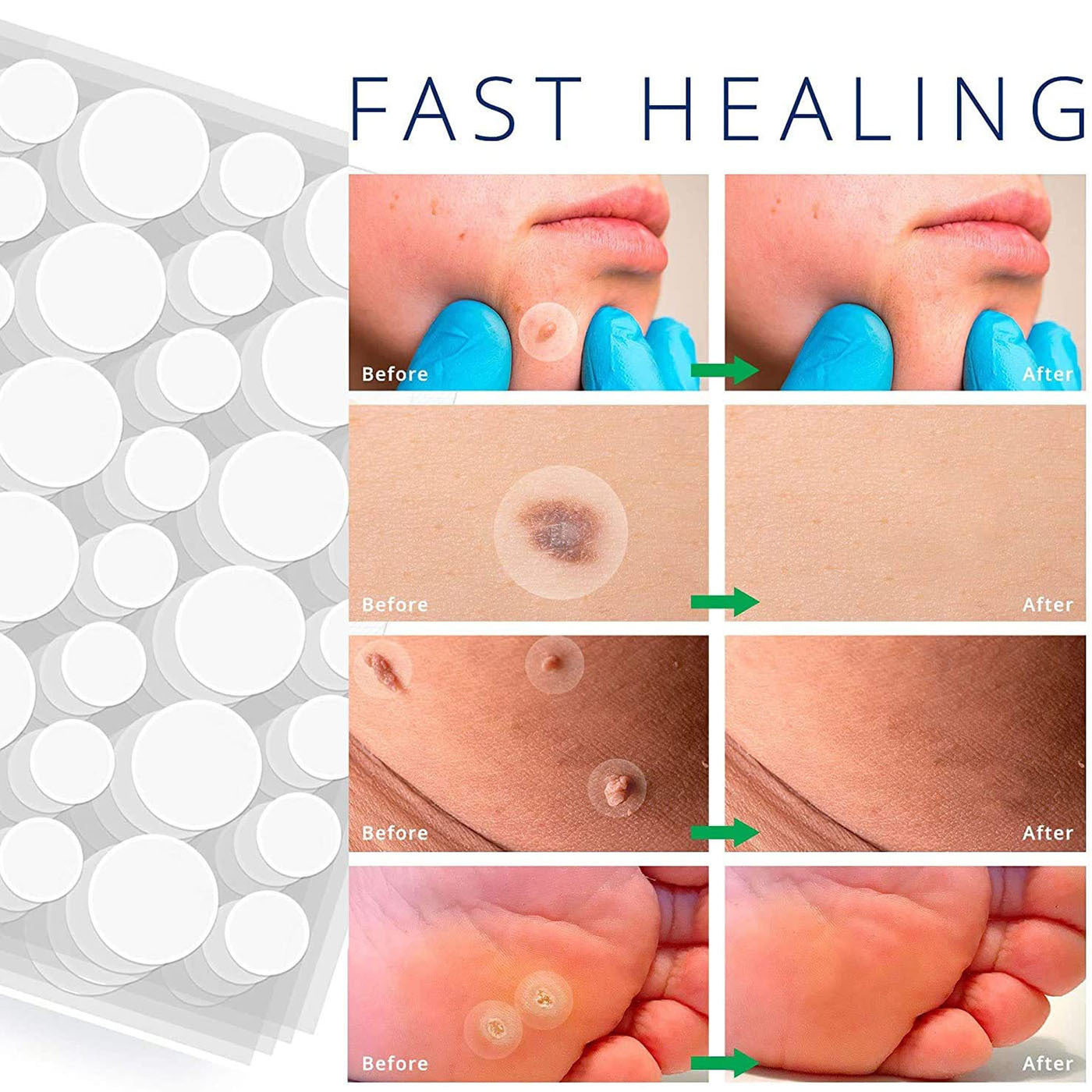 Adhesivo para el acné: se utiliza para reducir la inflamación en las zonas afectadas por el acné. 