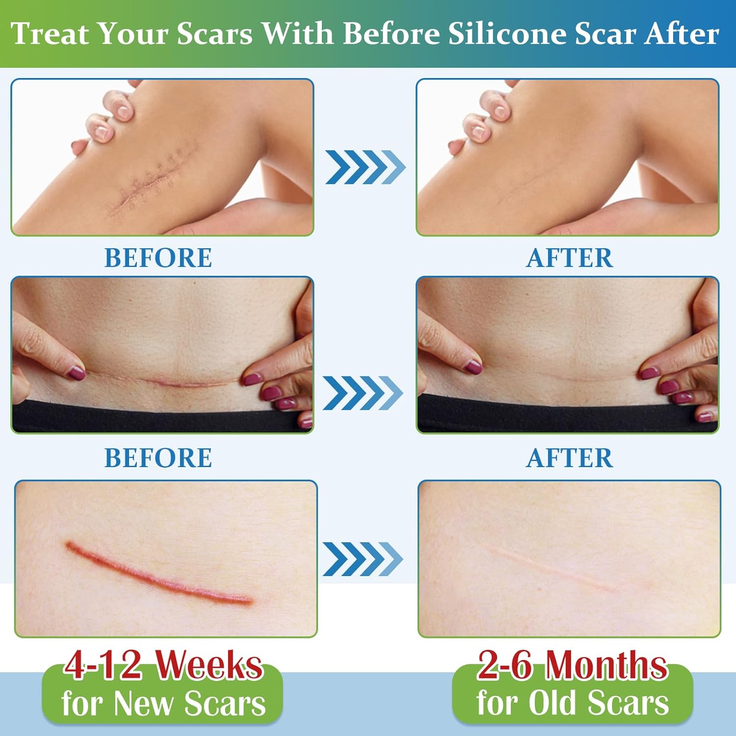 Kit de solución para cicatrices: gel crema para cicatrices + cinta de silicona para cicatrices