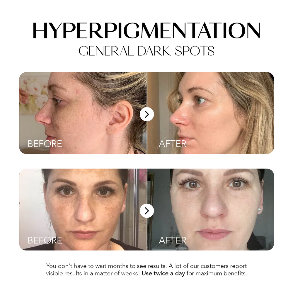 Dark Spot Corrector