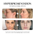 Dark Spot Corrector
